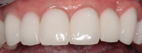CROWNS: Full Porcelain or Metal-Porcelain? - Image 1