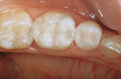 Finally, the ideal Dental Filling! - Image 1