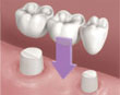 Implant or Bridge? - Image 1