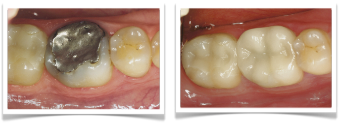 CEREC 1 Visit Computerized Dentistry
