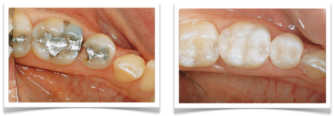 CEREC 1 Visit Computerized Dentistry