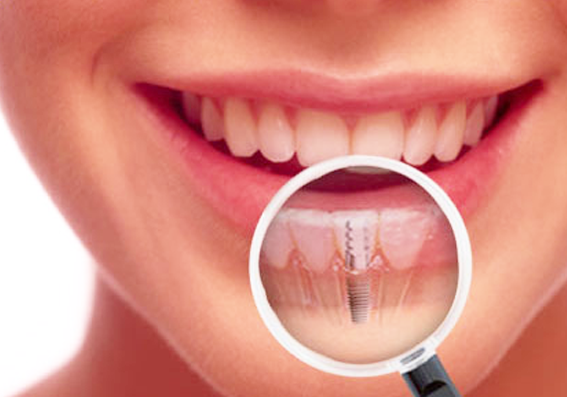 Why Dental Implants