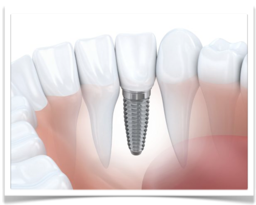 Why Dental Implants