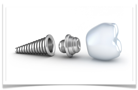 Dental Implants