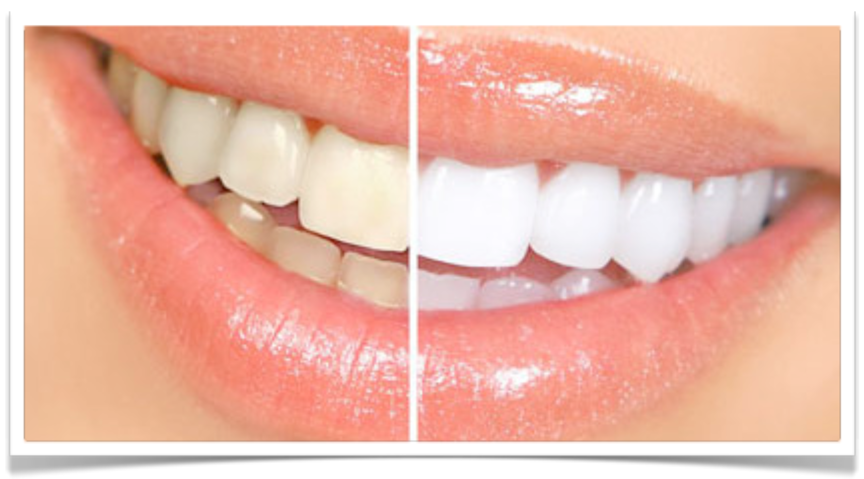 The Power of Teeth Whitening