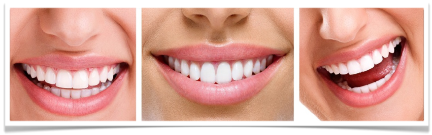 The Power of Teeth Whitening