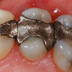 Metal Free Dentistry