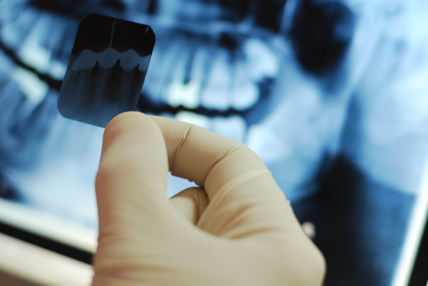 Are We Getting Too Much Radiation From Dental X-Rays?