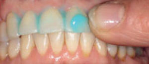 Brushing Teeth: New ‘Massage Method’ Quadruples Protection Against Tooth Decay, Study Suggests