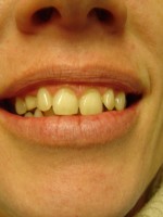 CEREC VENEERS (via mobile)