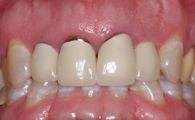 CROWNS: Full Porcelain or Metal-Porcelain?