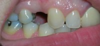 Do I have to replace a missing tooth? (video)
