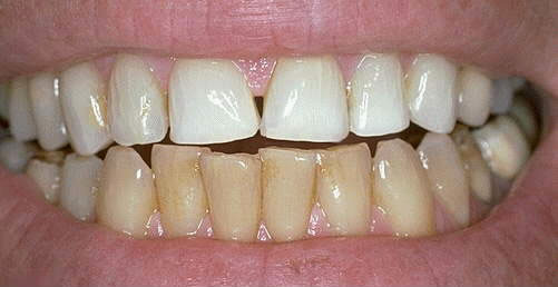 Do I need to Whiten my teeth first before I can get VENEERS?