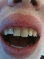 Gap between front teeth (via mobile)