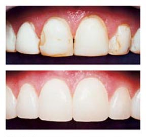 How Dental Bonding Can Alter the Look and Feel of Your Teeth?