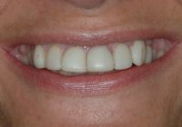 How do Veneers compare to Thineers? Which would you recommend?