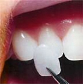 Let Dental Veneers be your ticket to a new you!