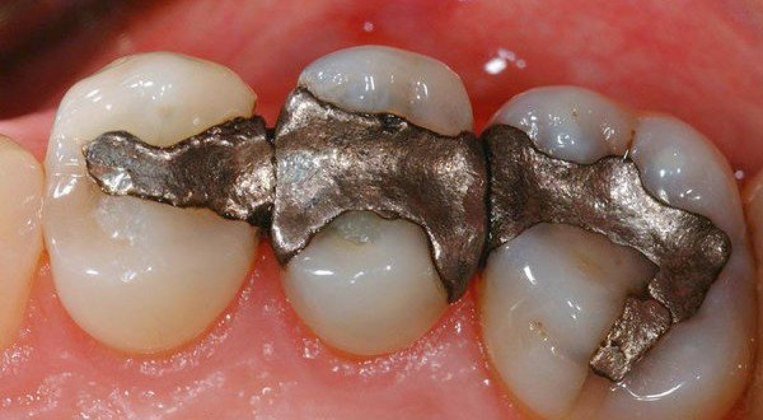 Metal Free Dentistry