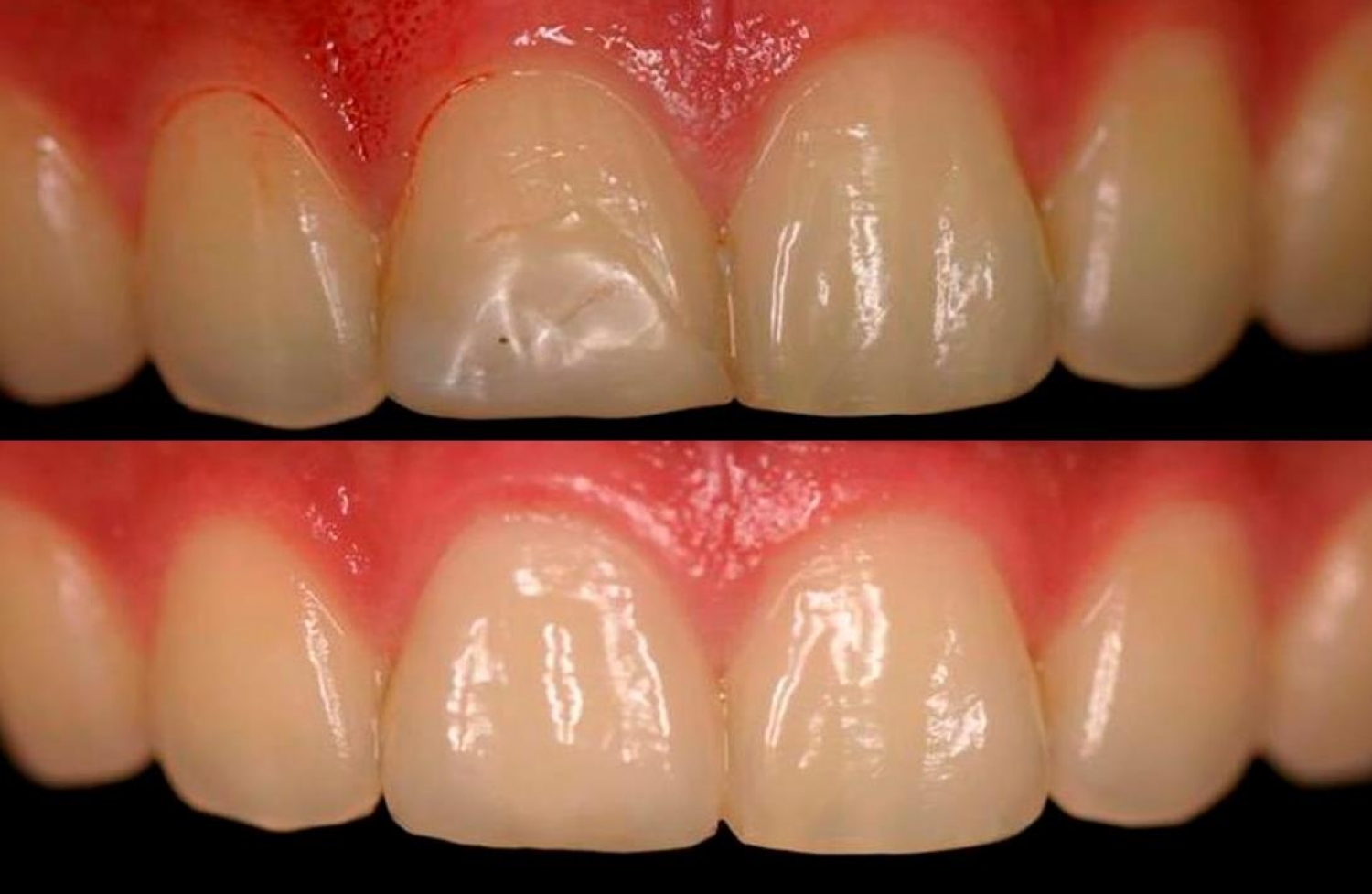 Dental Filling Front Teeth