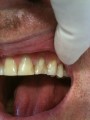 Tired of your patched front teeth?