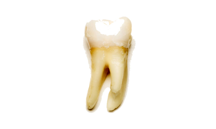 TOOTH REGENERATION GEL COULD REPLACE PAINFUL FILLINGS