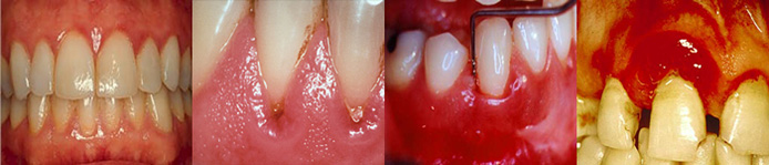 Why do my gums bleed?