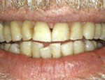 Yellow teeth…