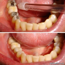 BEFORE:  Defective metal fillings.  AFTER:  New CEREC ceramic fillings all done in 1 visit.