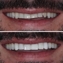 BEFORE: Tooth wear on upper 8 front teeth. AFTER: 8x Resin Veneers plus general ZOOM Teeth Whitening