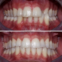 BEFORE: Cross Bite upper left lateral & Canine. AFTER: 6 Months treatment with ALF Appliance & Clear Aligners corrected the cross bite & Teeth whitening