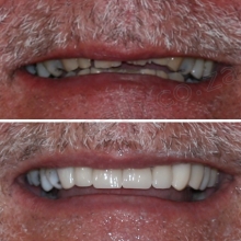 BEFORE: Uneven worn-down smile with minimal teeth showing. AFTER: 6 One visit cerec Crowns showing more teeth in smile