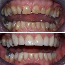 BEFORE: Gaps, yellow and chipped upper teeth. AFTER: 6 One visit Upper Cerec Porcelain Crowns and Teeth whitening for lower teeth