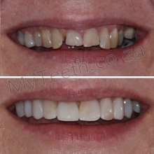 BEFORE: Uneven teeth, gaps & chipped edges. AFTER: Zero Preparation with 8 cost-effective resin Veneers all done with the Resin Injection Technique. Uneven shade can be corrected with freehand add-on, but patient happy with results. 
