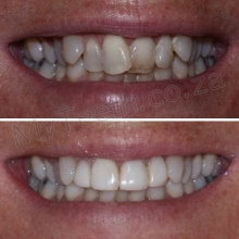 BEFORE: Patient unhappy with moderate crowding of front 4 teeth. Request a quick cosmetic solution and declined orthodontic treatment. AFTER: 1 Visit Resin Veneers with minimal preparation on front 4 teeth