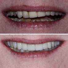 BEFORE: Patient unhappy with old dark crowns and kanting of smile. AFTER: 10 New Porcelain crowns improving kant and shade