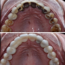 BEFORE: Unsightly Metal-Porcelain crowns and tooth wear. AFTER: New Porcelain crowns and bridge