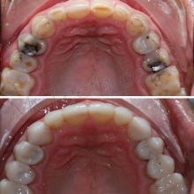 BEFORE: Tooth wear, Amalgam fillings, and stained teeth. AFTER: 10X Minimal Invasive resin build ups with the Resin Injection technique