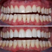 BEFORE: Tooth wear on 8 upper teeth and yellow tooth colour. AFTER: 8X Resin Veneers done in 1 Visit with Resin Injection Technique