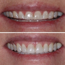 BEFORE: Uneven Smile line showing years of tooth wear. AFTER: 1 Visit Resin Veneers of 8 front teeth with Resin Injection Technique