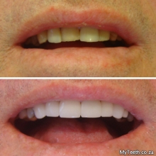 BEFORE: Patient wanted a new smile.  AFTER:  6 CEREC porcelain veneers on front teeth restore the smile to a more youthful smile. All in 1 visit.