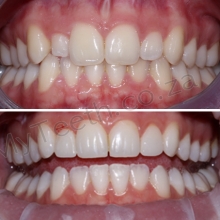 BEFORE: Peg laterals and patient unhappy with colour. AFTER: 2 Resin Veneers on centrals plus 2 Cerec Veneers on laterals and  with teeth whitening