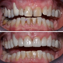 BEFORE: Upper 6 teeth uneven, spaces, stained and incorrect colour of molars. AFTER: Upper 6 resin veneers showing better colour match & new porcelain crowns on back molars
