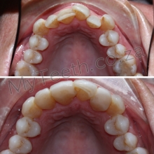 BEFORE: Small upper arch showing crowding of teeth. AFTER: 1 Visit Resin Veneers with zero preparation on 4 front teeth only. This demonstrates that even in extreme cases, good aesthetic results can still be obtained.