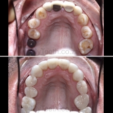 BEFORE: Tooth wear, Implant healing caps & old metal-porcelain crowns. AFTER: 12 new Porcelain metal-free cerec crowns