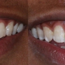 BEFORE: Patient unhappy with front gap. AFTER: Front gap closed in one visit with zero-prep resin veneers