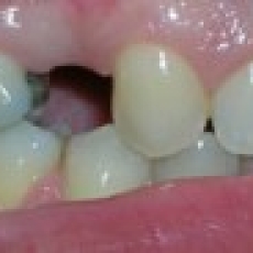 Do I have to replace a missing tooth? (video)