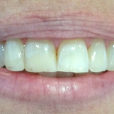 Smile Project: 2