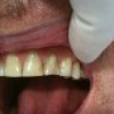 Tired of your patched front teeth?
