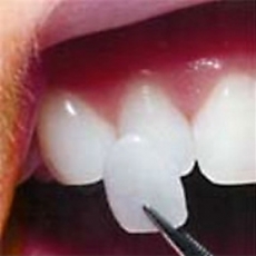 Let Dental Veneers be your ticket to a new you!