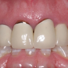 CROWNS: Full Porcelain or Metal-Porcelain?